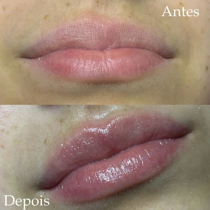 Antes e depois de micropigmentação labial
